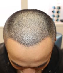 -大麦微针植发全国连锁