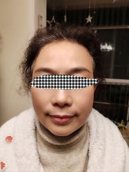 体验后-四川米兰柏羽医学美容医院