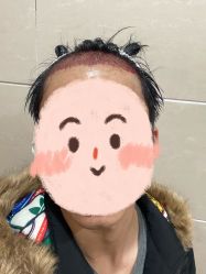 -大麦微针植发丨全国连锁