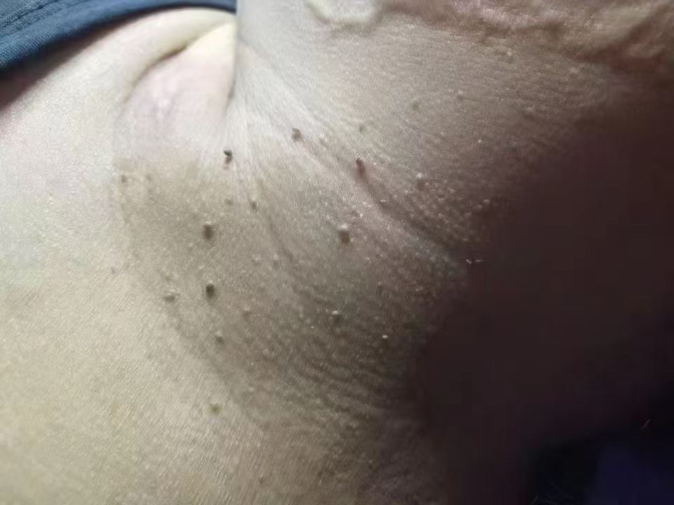 
脖子上的丝状疣,扁平