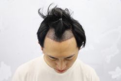 -大麦微针植发丨全国连锁