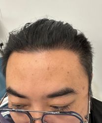 点击看大图 -大麦微针植发全国连锁