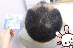 点击看大图 -大麦微针植发丨全国连锁