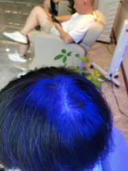 -碧莲盛·不剃发植发