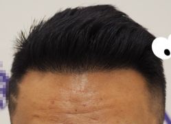 -大麦微针植发全国连锁