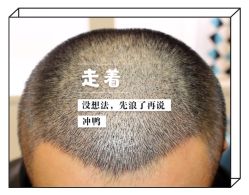 -大麦微针植发全国连锁