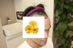 -大麦微针植发丨全国连锁