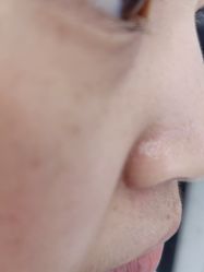 体验前-蕾特恩专业祛痘·皮肤管理