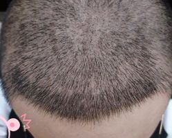 -大麦微针植发丨全国连锁