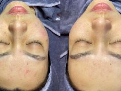 -苗方清颜痘肌研究所