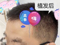 -大麦微针植发全国连锁