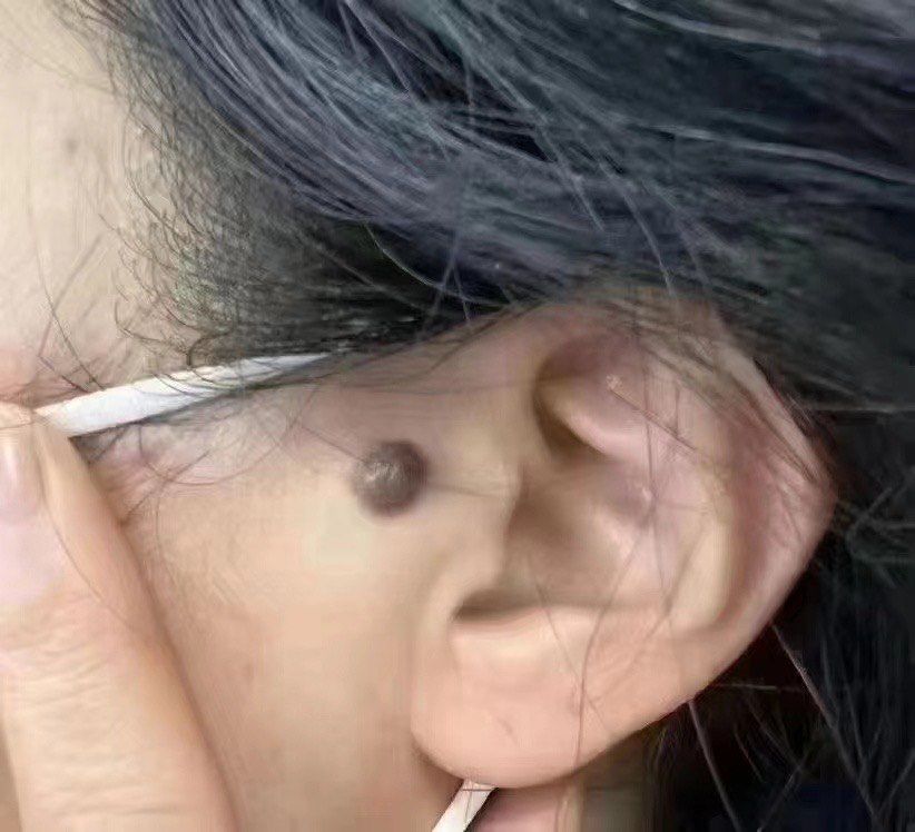 看看这颗痣你🈶么?