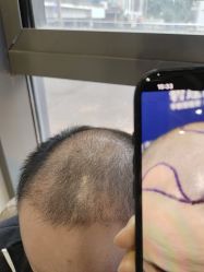 -碧莲盛·不剃发植发