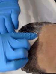 -大麦微针植发全国连锁