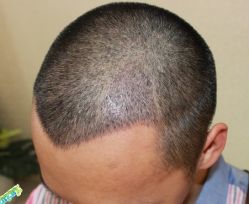 -大麦微针植发丨全国连锁