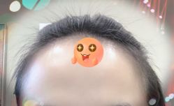 -大麦微针植发全国连锁