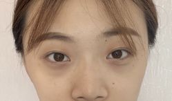 -天津健丽·去眼袋医疗美容机构