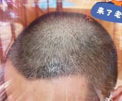 -大麦微针植发全国连锁