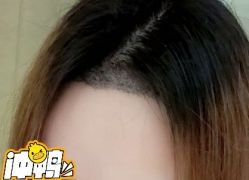 -大麦微针植发全国连锁