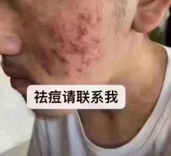 -苗方清颜专业祛痘连锁机构