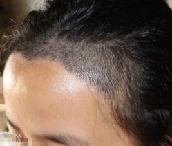 -大麦微针植发丨全国连锁