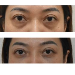 -广州健丽·去眼袋医疗美容机构