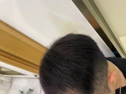-碧莲盛·不剃发植发