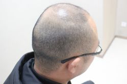 点击看大图 -大麦微针植发丨全国连锁