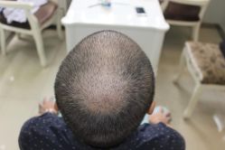 -大麦微针植发丨全国连锁