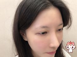 -大麦微针植发丨全国连锁