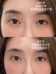 体验前-深圳春天阳光医院·轮廓抗衰中心