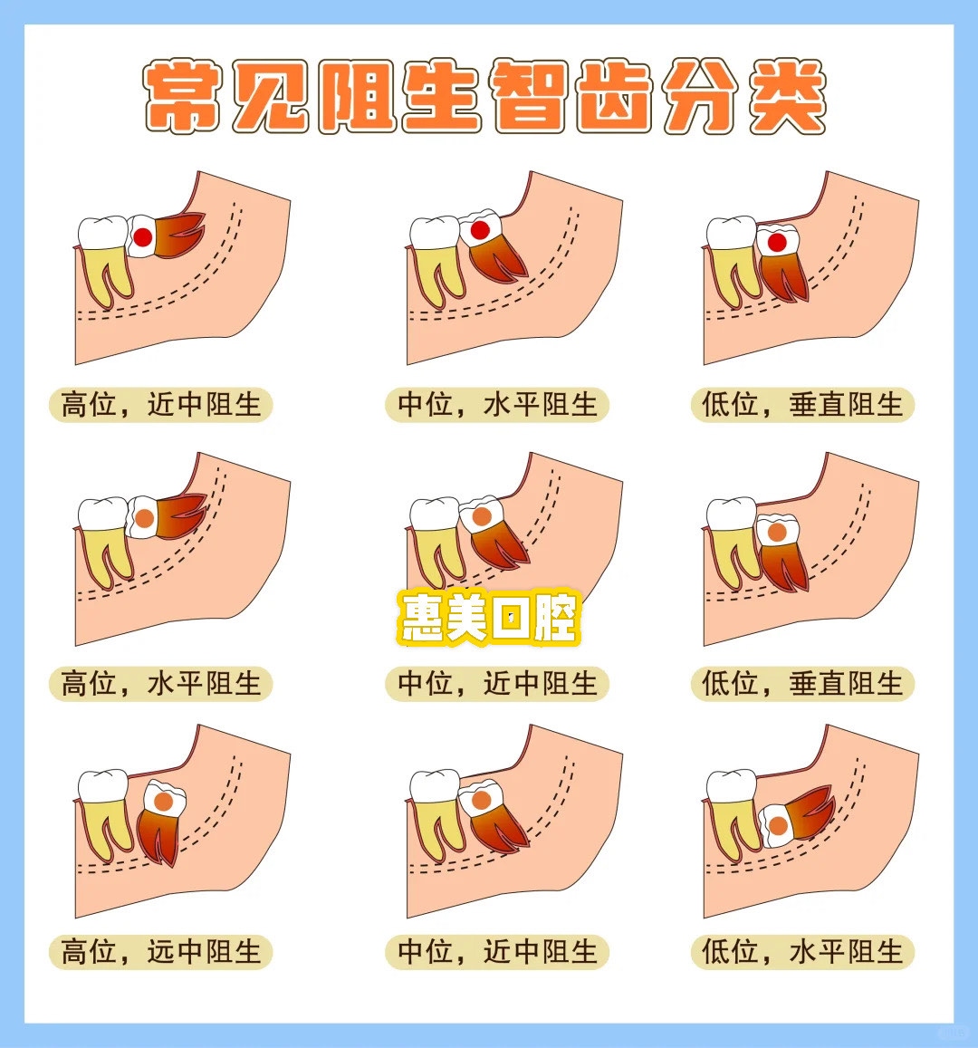 阻生牙分类图片图片