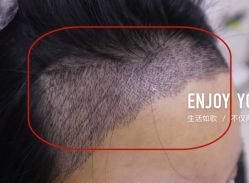 -大麦微针植发全国连锁