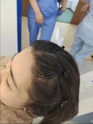 -大麦微针植发全国连锁