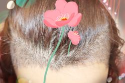 -大麦微针植发全国连锁