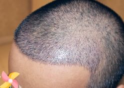 -大麦微针植发丨全国连锁