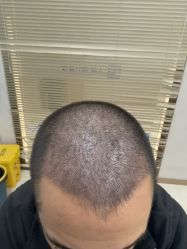 -大麦微针植发丨全国连锁