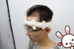 -大麦微针植发丨全国连锁