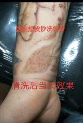 -微刺纹身