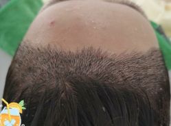 -大麦微针植发丨全国连锁