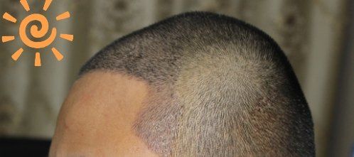 -大麦微针植发丨全国连锁