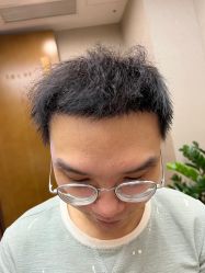 体验后-大麦微针植发全国连锁