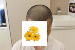 -大麦微针植发丨全国连锁