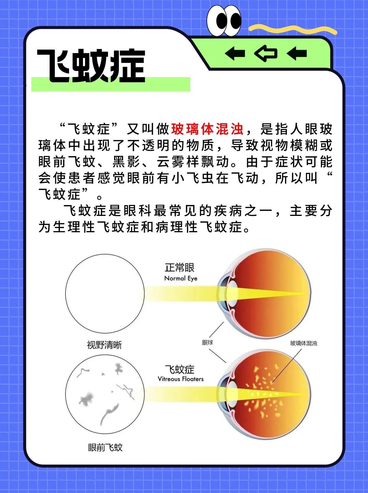眼前总有黑影怎么办?一分钟了解飞蚊症!