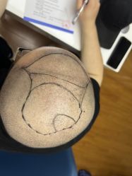 -大麦微针植发全国连锁