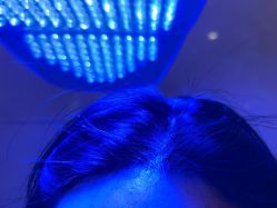 -碧莲盛·不剃发植发