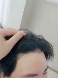 -大麦微针植发丨全国连锁