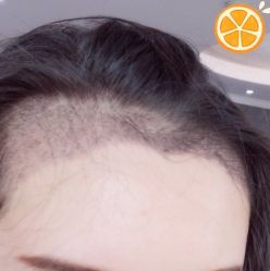 -大麦微针植发丨全国连锁