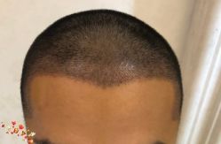 -大麦微针植发丨全国连锁