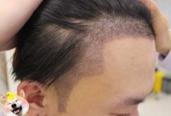 -大麦微针植发丨全国连锁